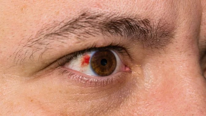 Krvácení pod spojivkou. Po tupém tlaku předmětem se projevuje jako červená skvrnka na bělmu. Navzdory zastrašujícímu vzhledu zranění nebývá vážné a zpravidla spontánně zmizí do 7 až 14 dnů
