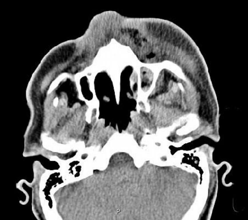 Obr. 5 – Invazívní zygomykóza v oblasti PND na CT – z archívu Radiologické kliniky LF MU a FN Brno