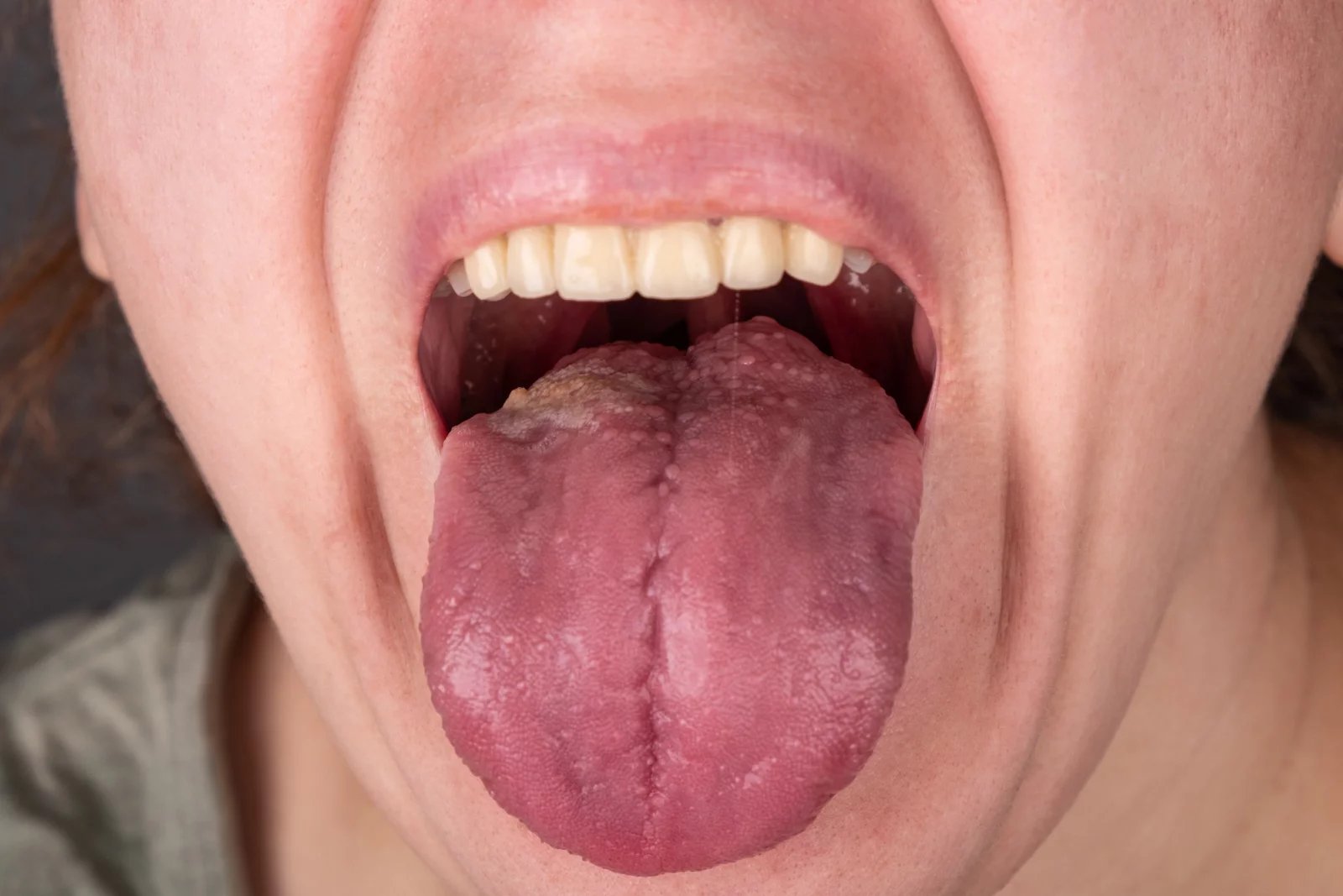 Pokud vás trápí malé hrbolky na jazyku, které mohou být zbarvené buď doběla, nebo dočervena, může jít o symptomy lingvální papilitidy. Jde v podstatě o zánět papil a může se objevit jedna osamocená, nebo jich může být i více.