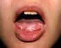 Původcem moučnivky, odborně též ústní kandidózy, jsou kvasinky z rodu Candida. Tato mykotická nemoc vypadá na pohled jako skupina šedobílých flíčků na jazyku, které občas doprovází i červené léze.