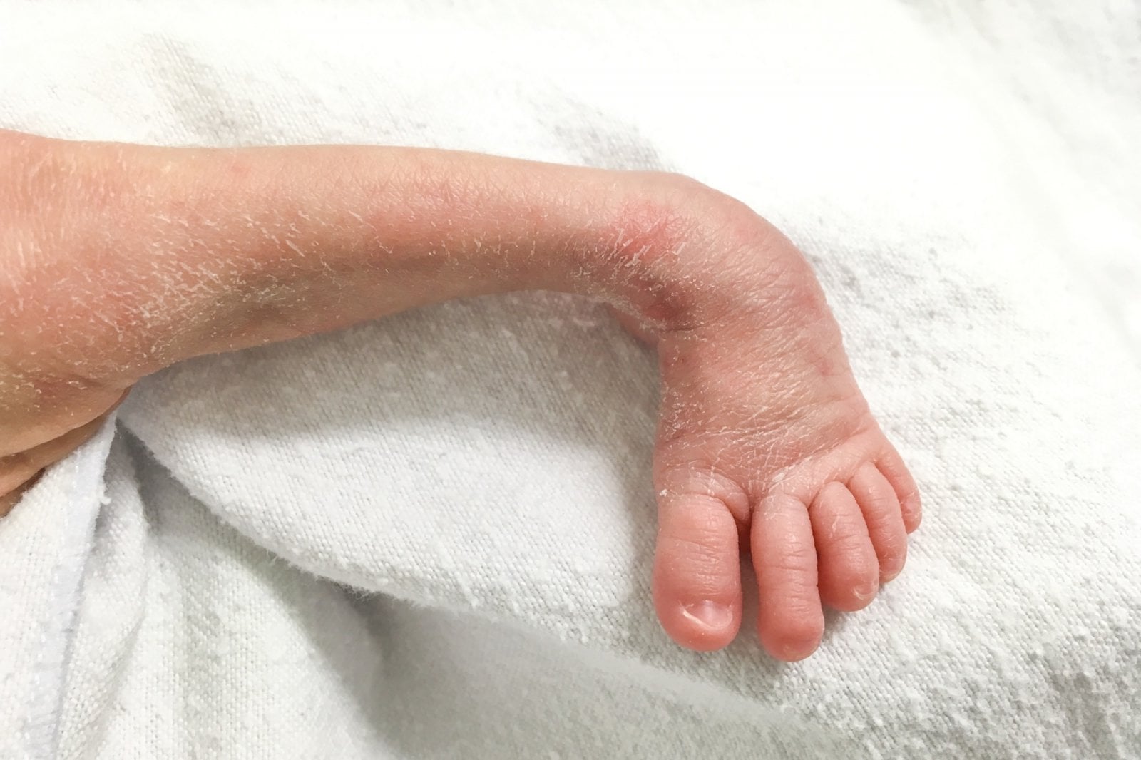 Léčba a projevy golfové nohy