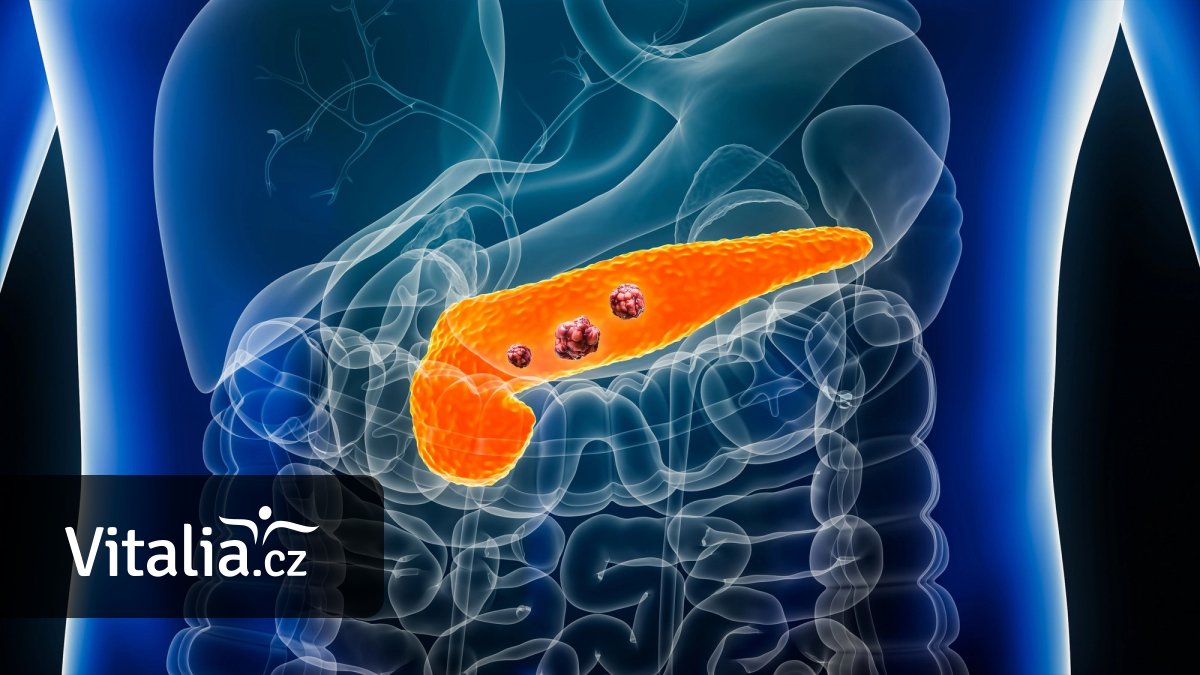 Běží prevence zaměřená na odhalení nádoru slinivky, jakým trpí expremiér Topolánek