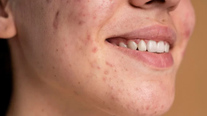 Uhry a boláky se snažte nemačkat. Pleť akorát podráždíte a zánět se rozšíří dál