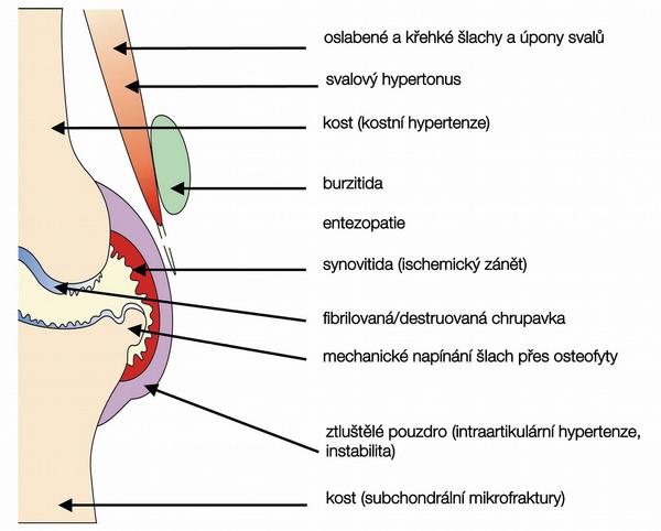 Obr. – Mechanismus bolesti u artrózy