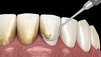 Náhledový obrázek - Odstranění zubního kamene přenechte odborníkům. Nejčastěji se používá škrabka a ultrazvuk