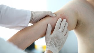 Náhledový obrázek - Bolest kůže na dotek může souviset s popálením, infekcí i alergií. Někdy je nutné vyhledat lékaře