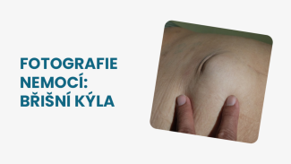 Náhledový obrázek - Břišní kýla fotografie: jejím nejvýraznějším rysem je bulka pod kůží