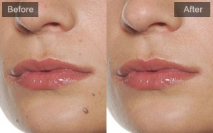 Free Photo Blemish Remover  - náhled